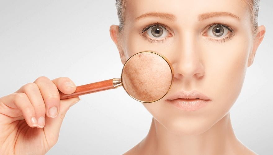 درمان لک و تیرگی پوست با استفاده از اسید ها