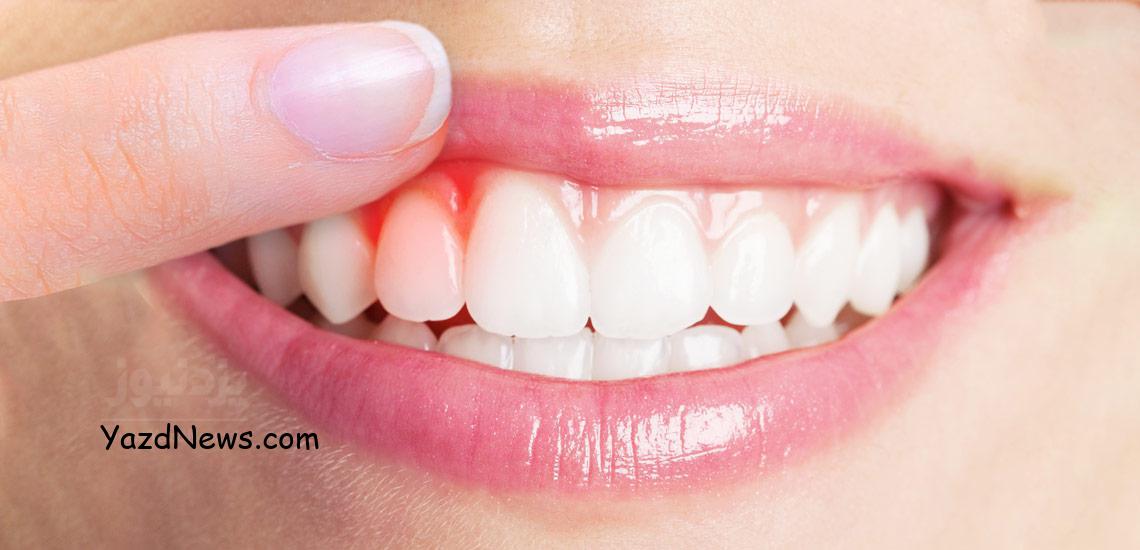 لثه متورم ، دلیل تورم و قرمزی لثه های اطراف یک دندان و راهکار های درمانی 